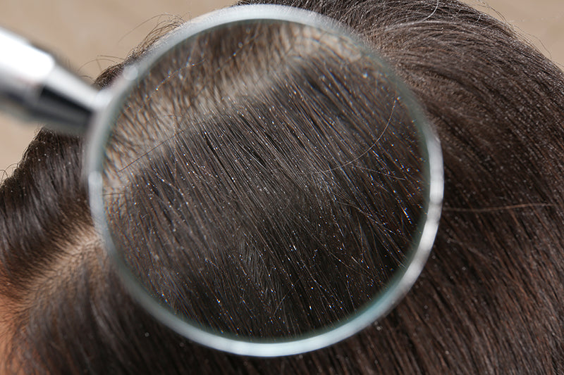 How To Get Rid Of Your Dandruff With BioCare Labs Products!